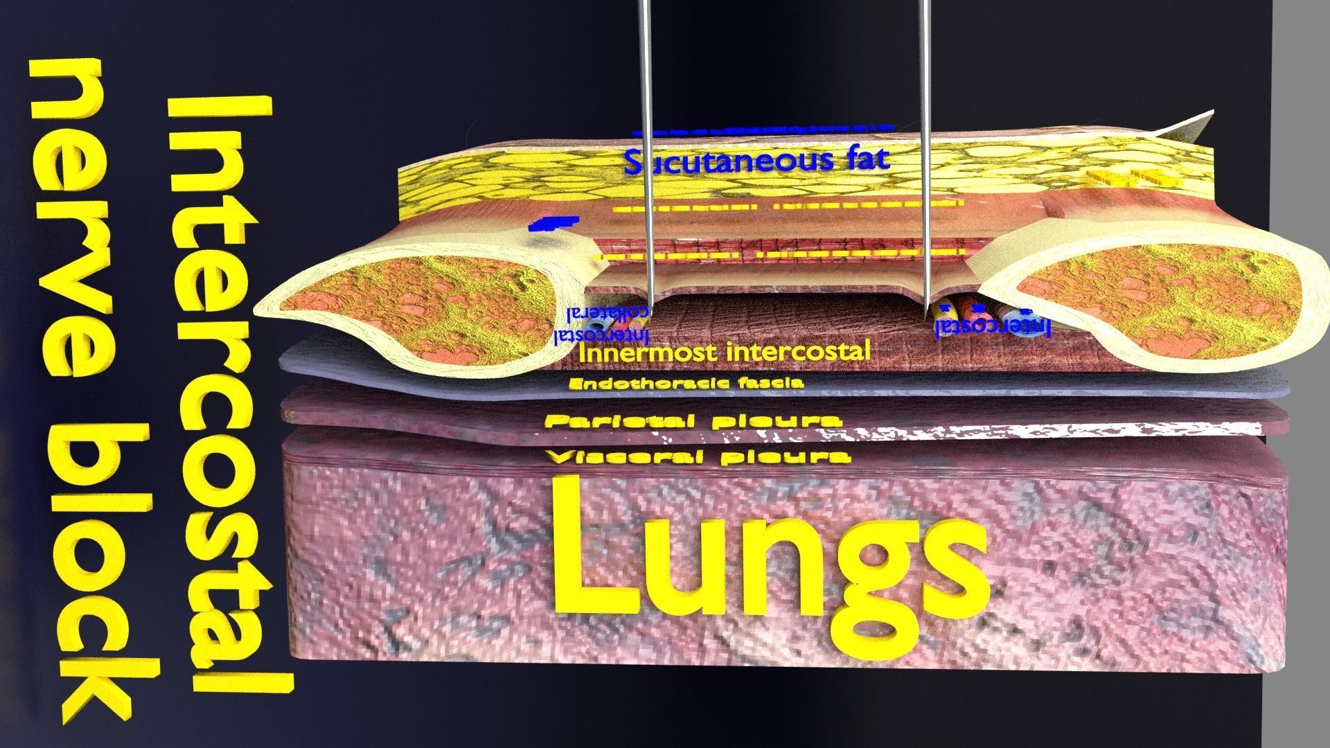 thorax thoracotomy thoracocentesis intercostal nerve block 3D model_26