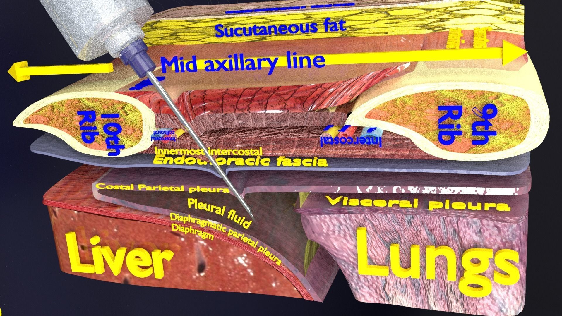 thorax thoracotomy thoracocentesis intercostal nerve block 3D model_17