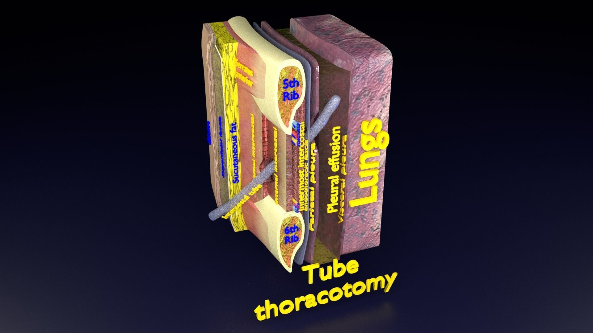 thorax thoracotomy thoracocentesis intercostal nerve block 3D model_40