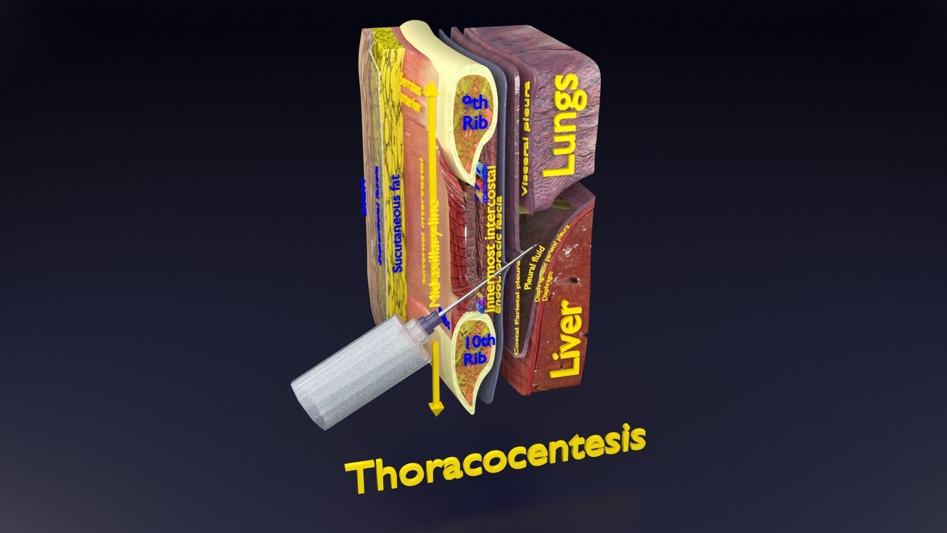 thorax thoracotomy thoracocentesis intercostal nerve block 3D model_64