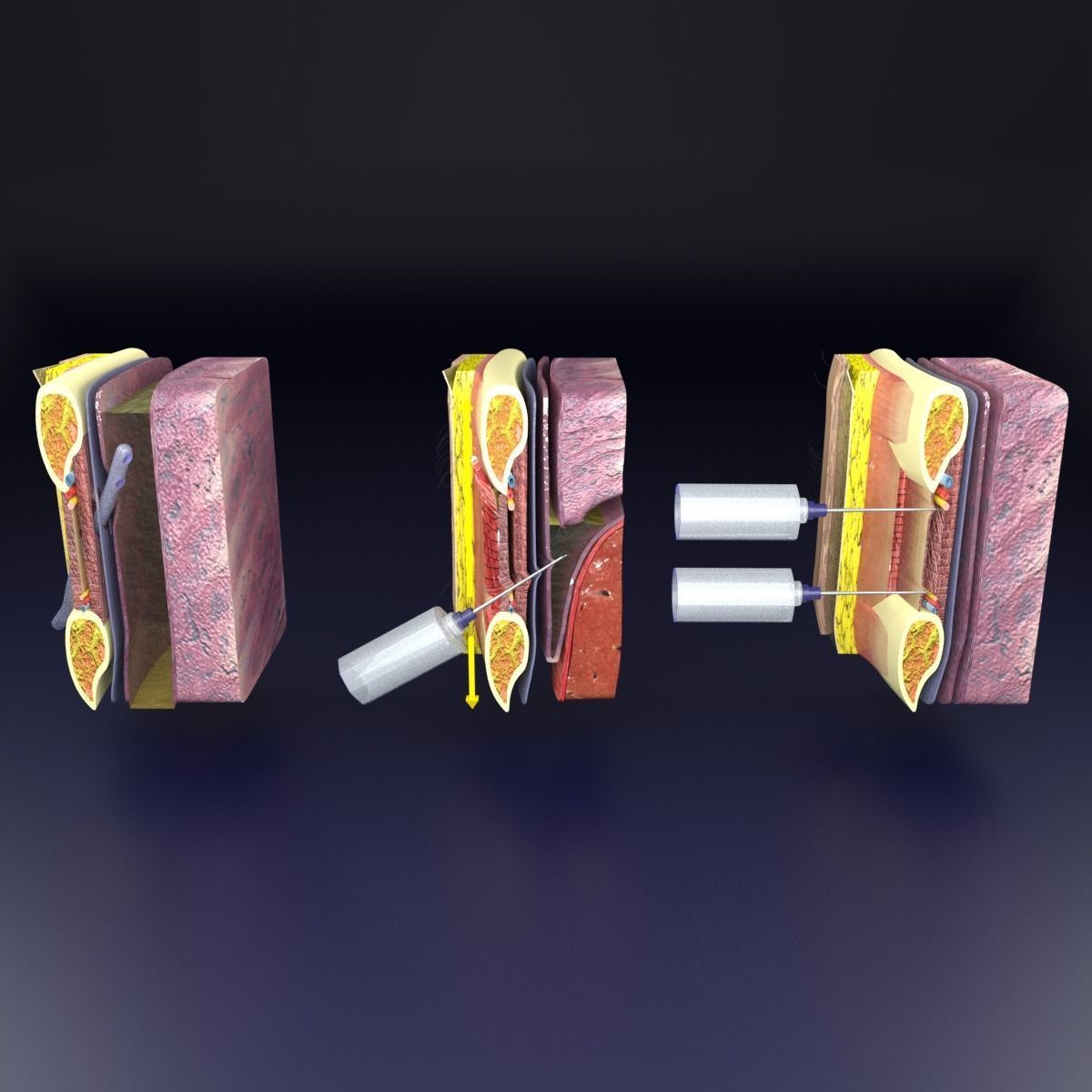 thorax thoracotomy thoracocentesis intercostal nerve block 3D model_7