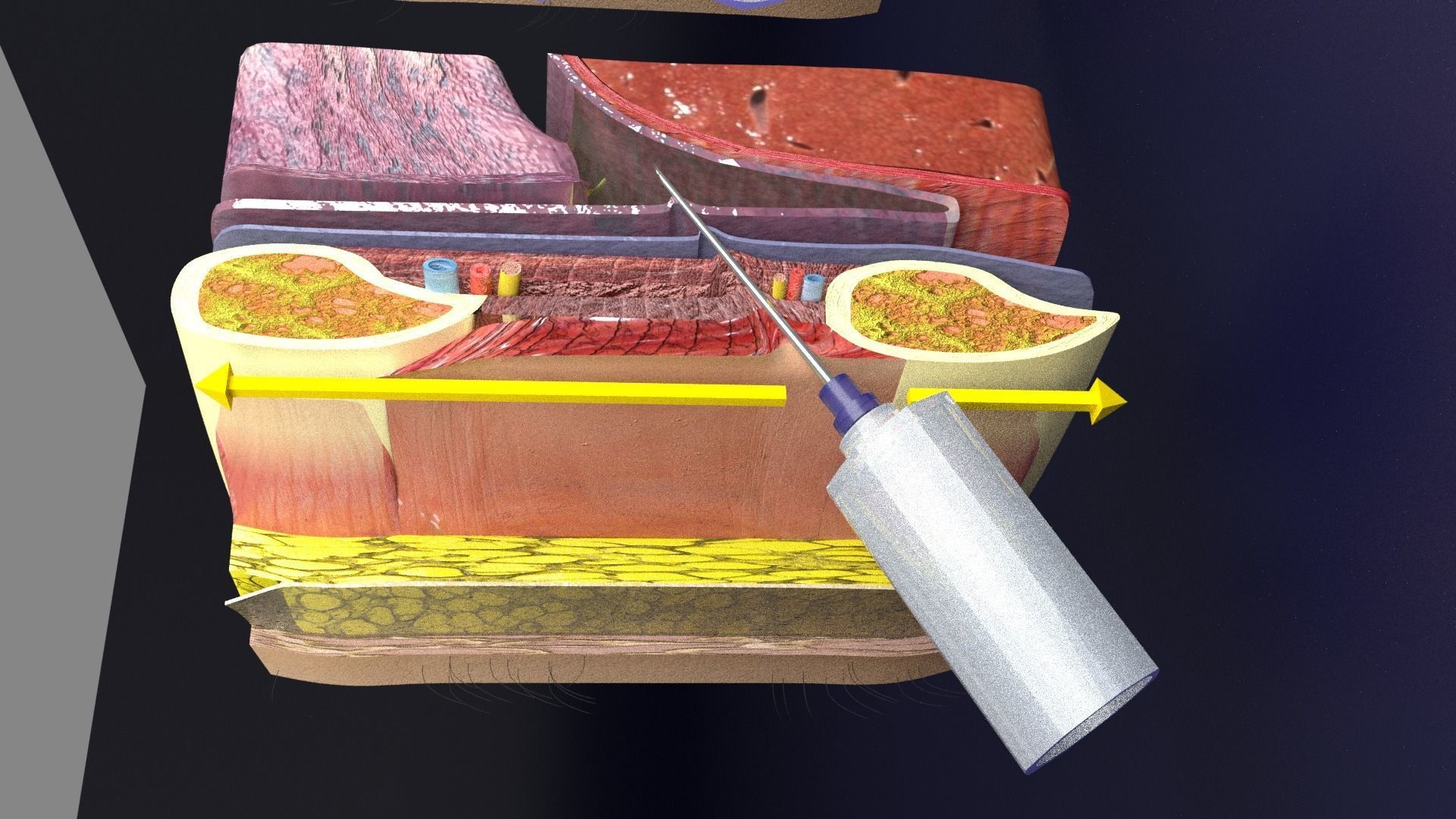 thorax thoracotomy thoracocentesis intercostal nerve block 3D model_5