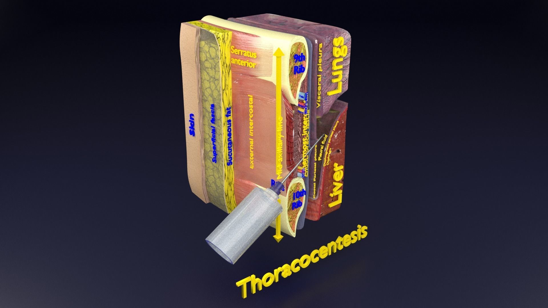 thorax thoracotomy thoracocentesis intercostal nerve block 3D model_60