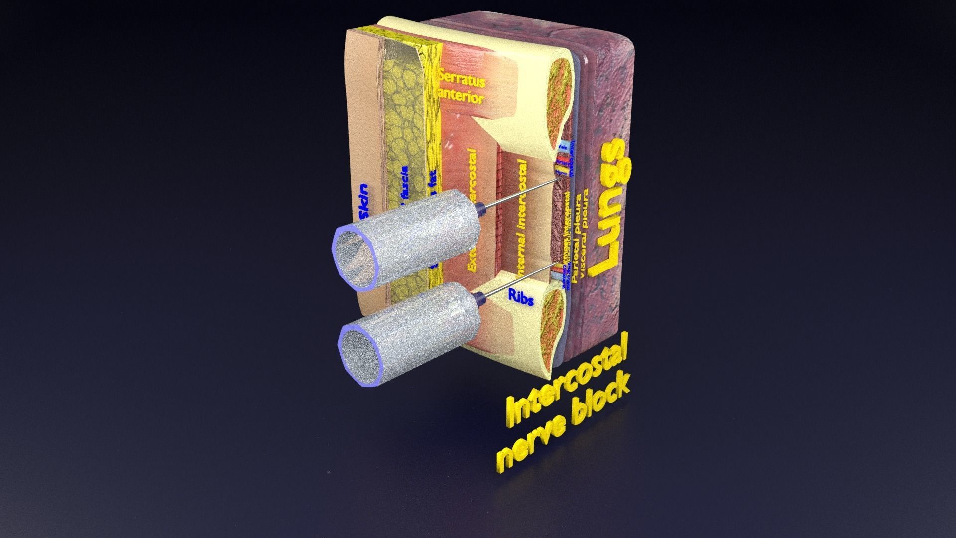thorax thoracotomy thoracocentesis intercostal nerve block 3D model_91