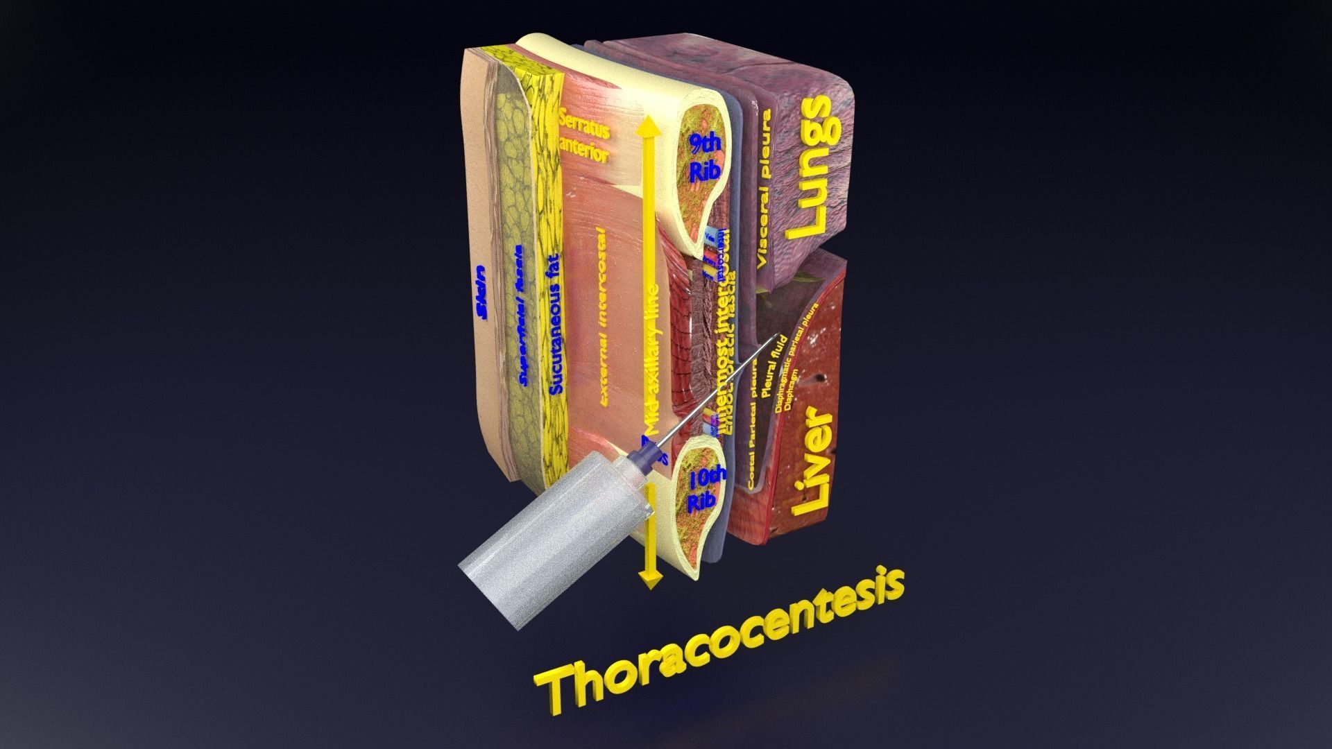 thorax thoracotomy thoracocentesis intercostal nerve block 3D model_72
