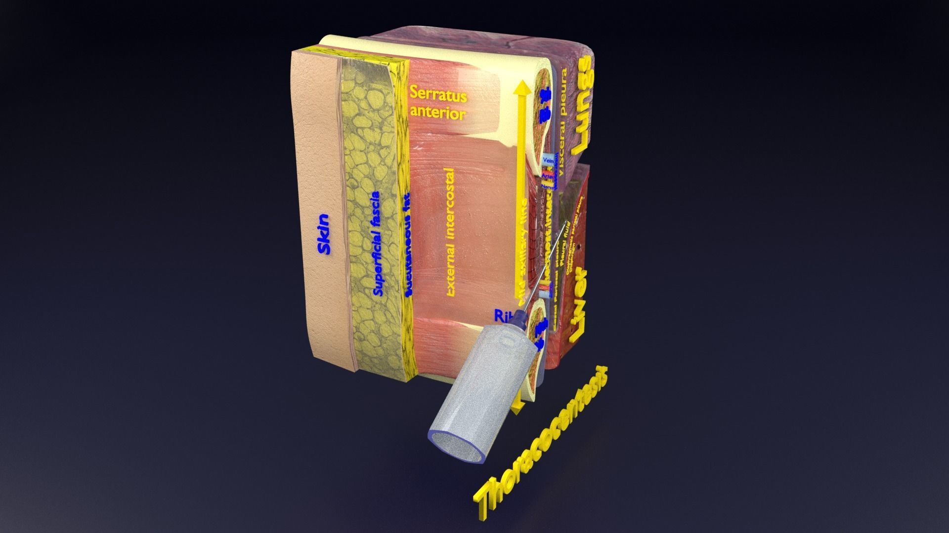 thorax thoracotomy thoracocentesis intercostal nerve block 3D model_63