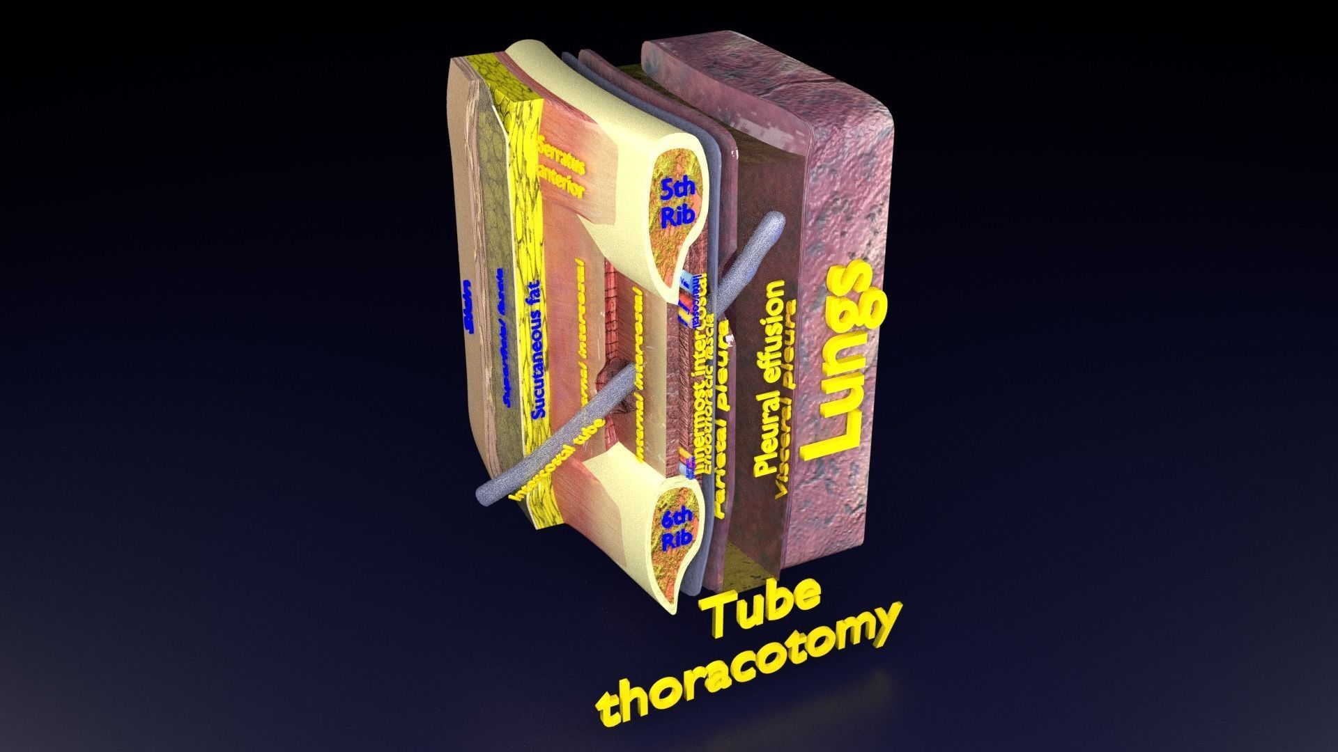 thorax thoracotomy thoracocentesis intercostal nerve block 3D model_39