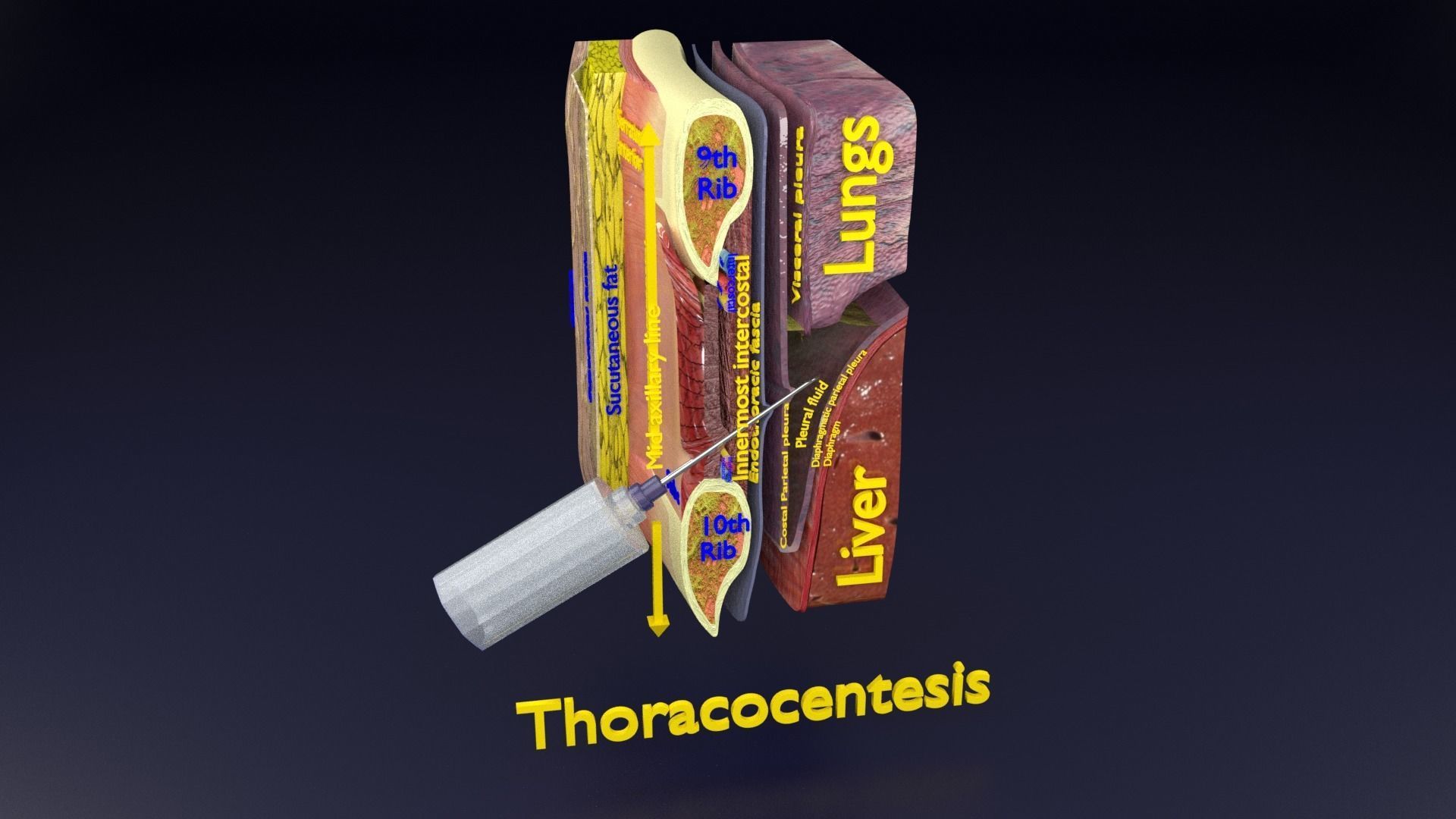 thorax thoracotomy thoracocentesis intercostal nerve block 3D model_61
