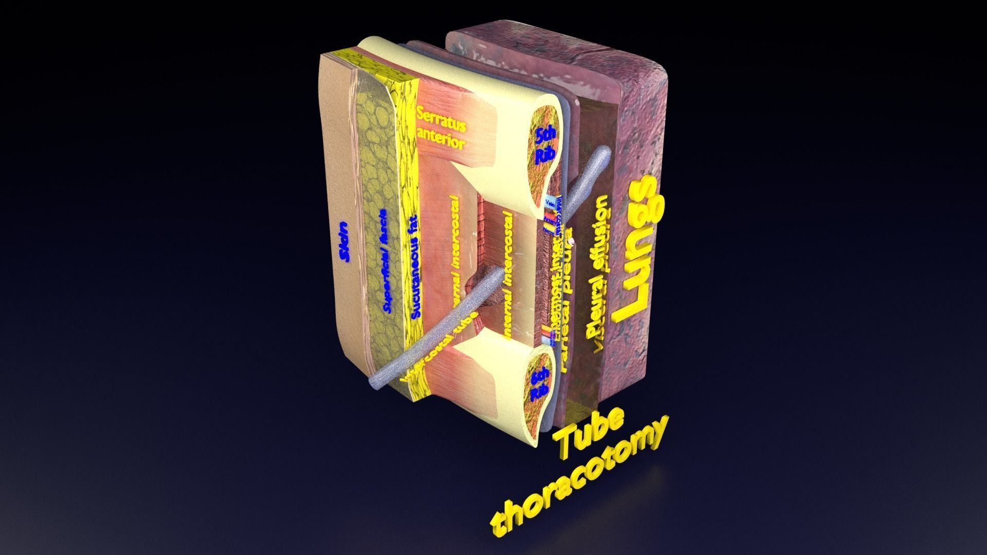 thorax thoracotomy thoracocentesis intercostal nerve block 3D model_48