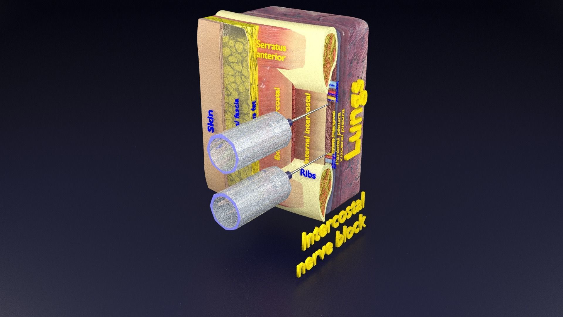 thorax thoracotomy thoracocentesis intercostal nerve block 3D model_98