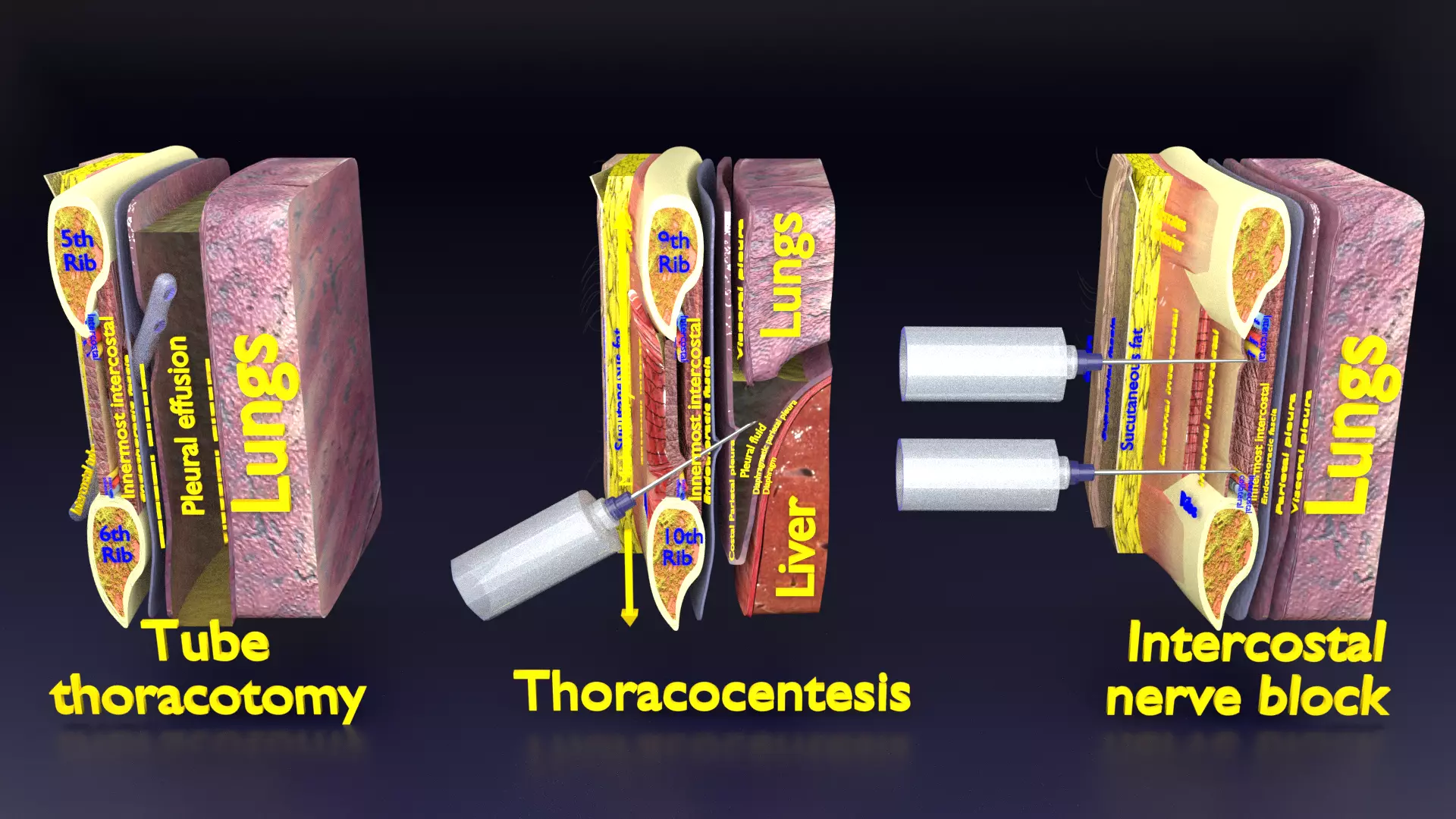 thorax thoracotomy thoracocentesis intercostal nerve block 3D model_0