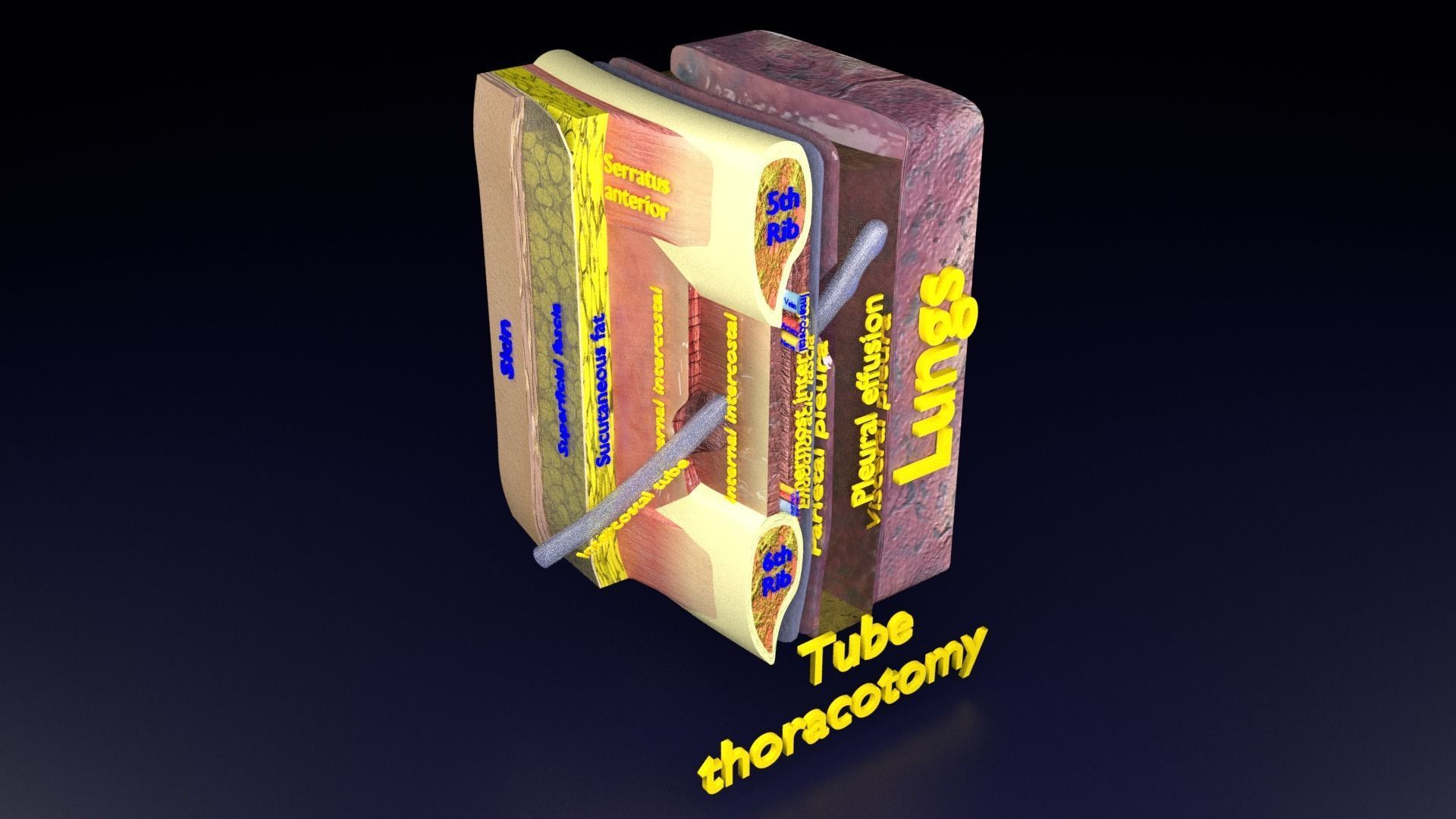 thorax thoracotomy thoracocentesis intercostal nerve block 3D model_46