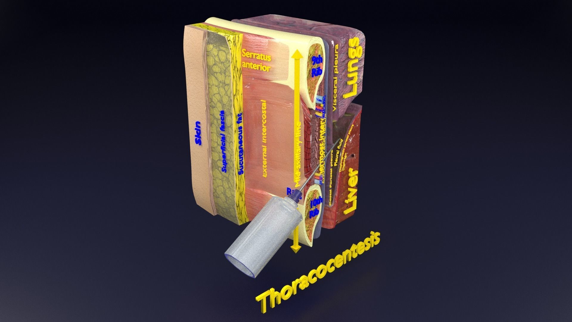 thorax thoracotomy thoracocentesis intercostal nerve block 3D model_75