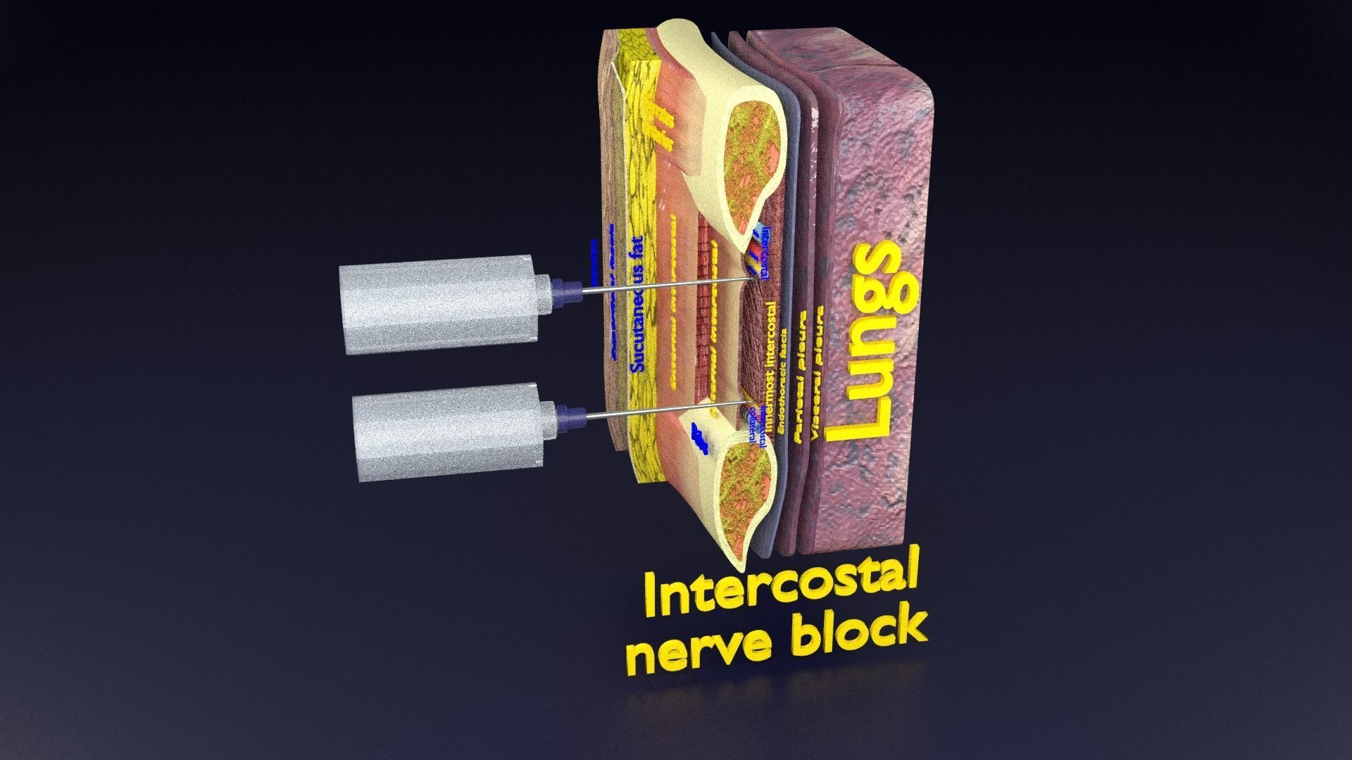 thorax thoracotomy thoracocentesis intercostal nerve block 3D model_85