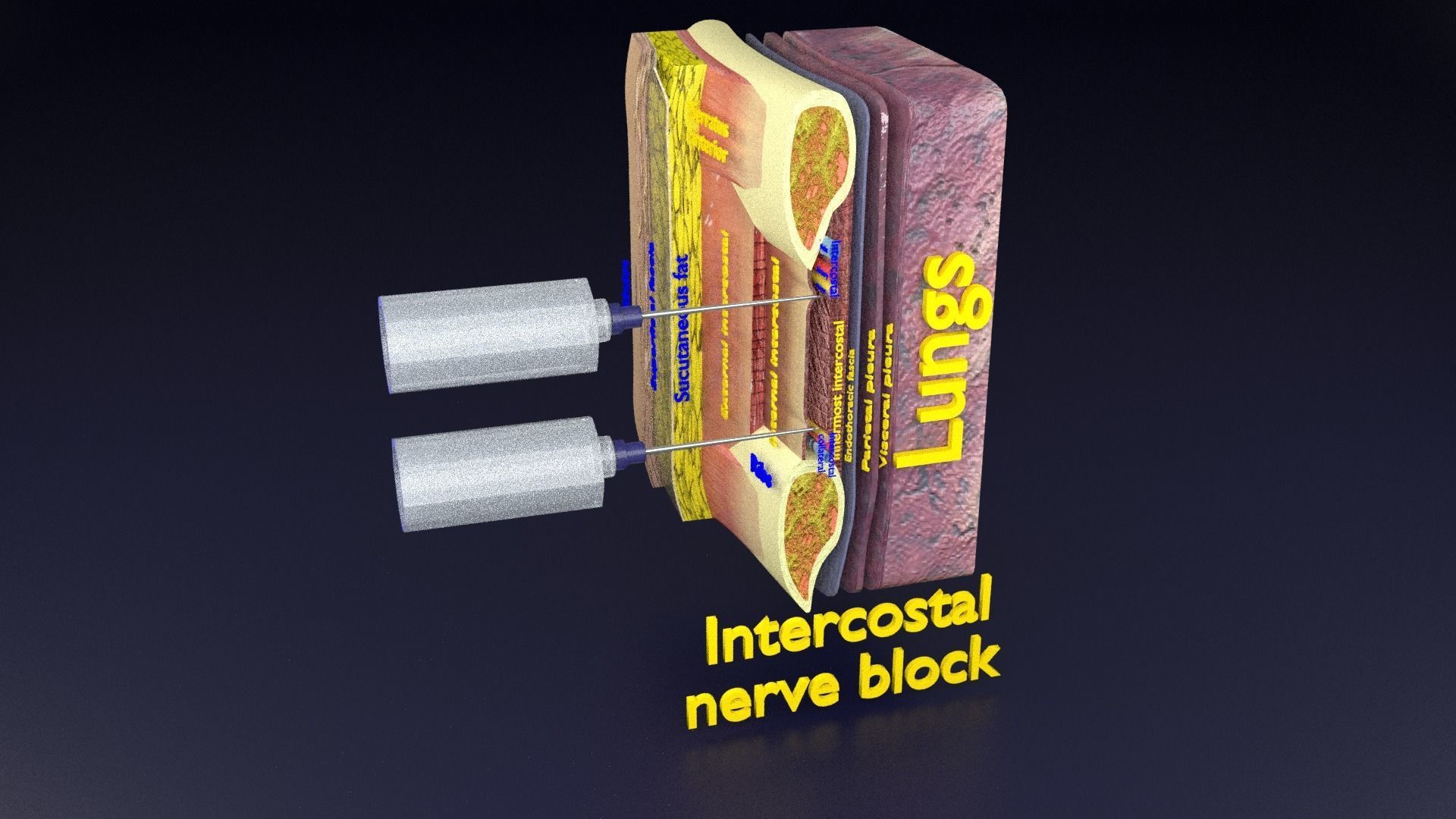 thorax thoracotomy thoracocentesis intercostal nerve block 3D model_88