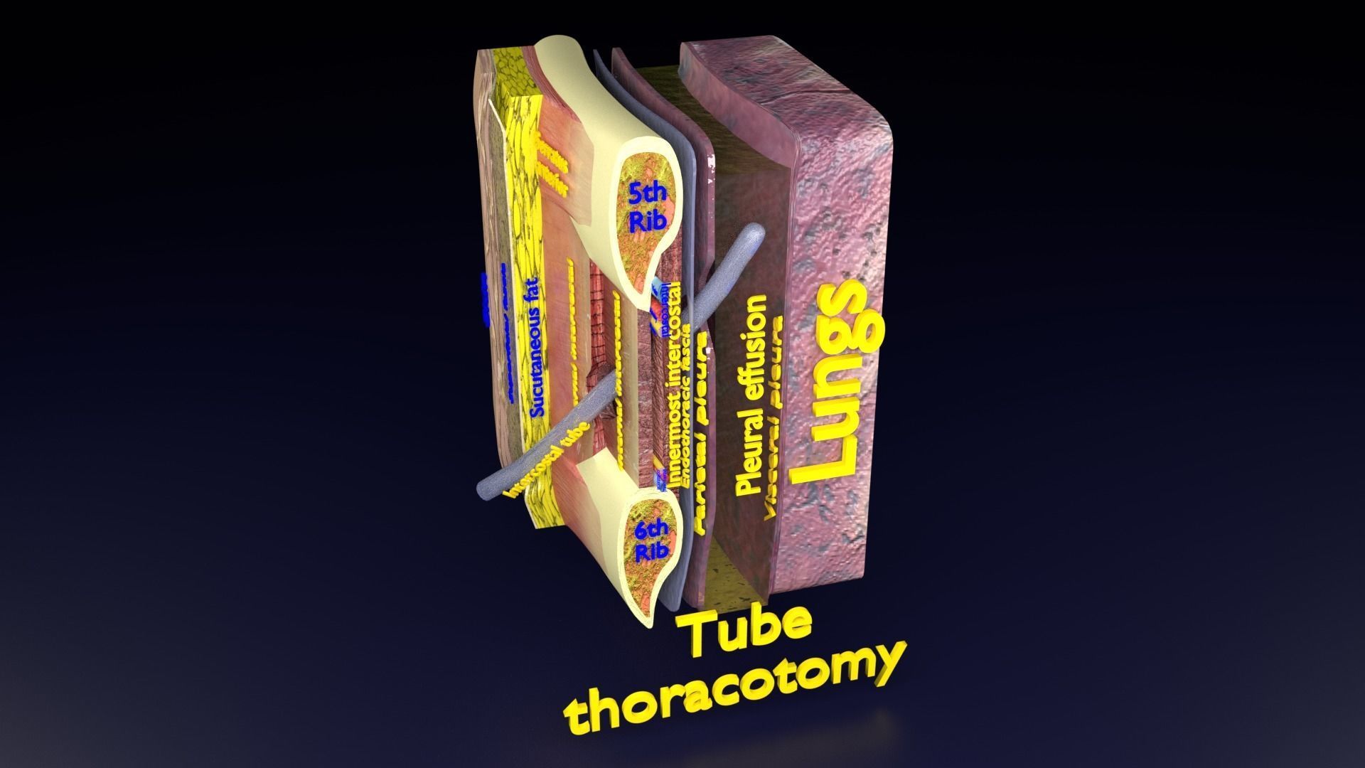 thorax thoracotomy thoracocentesis intercostal nerve block 3D model_44