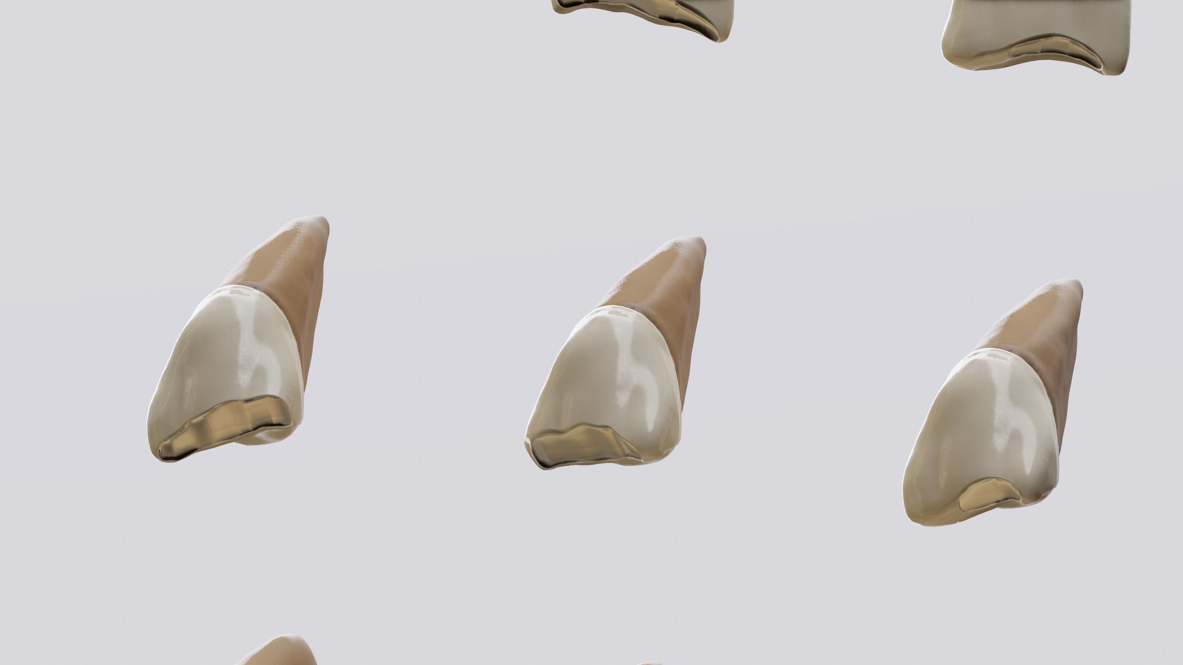 Permanent Teeth class 4 Caries 3D model_4