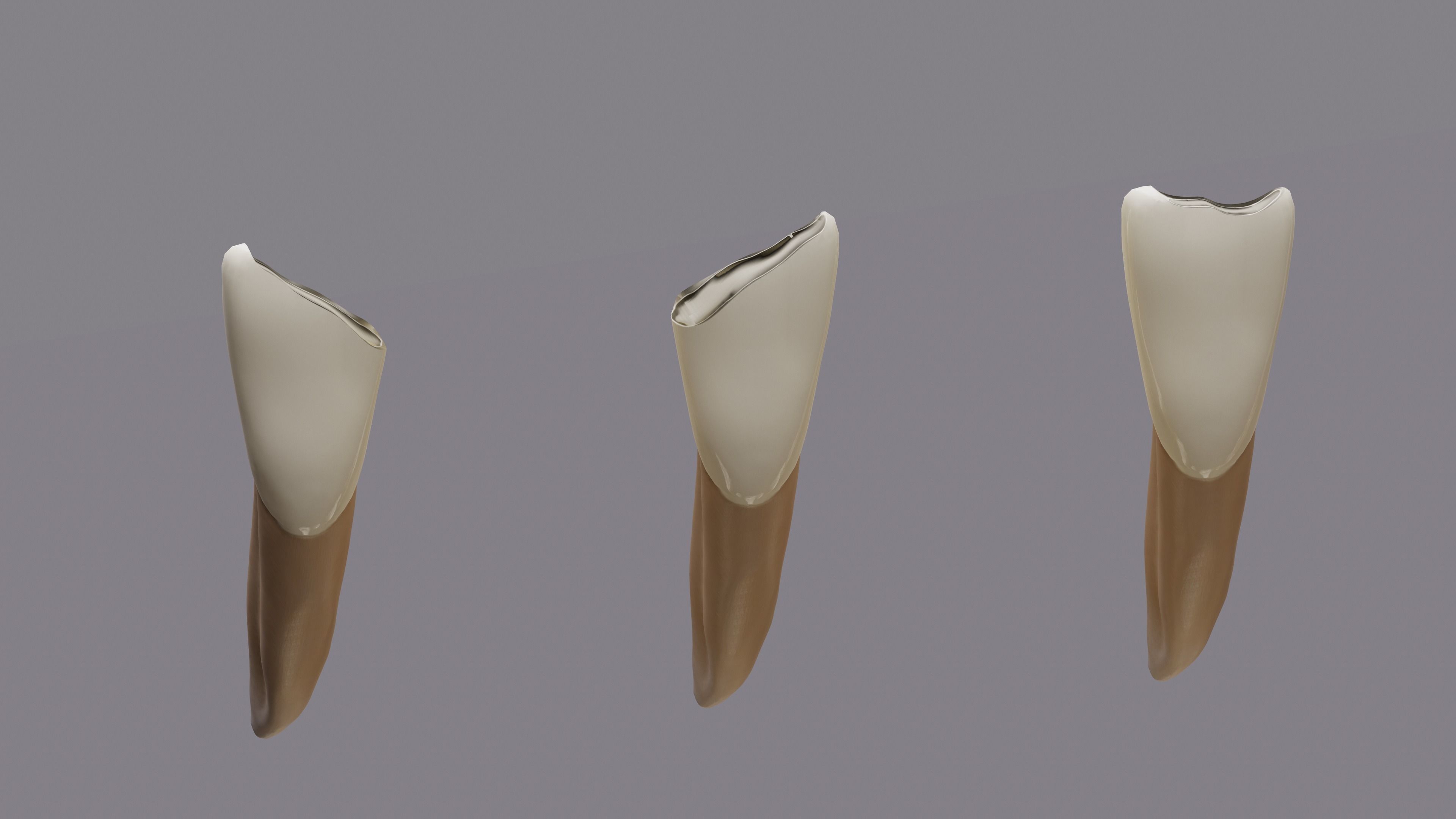 Permanent Teeth class 4 Caries 3D model_8