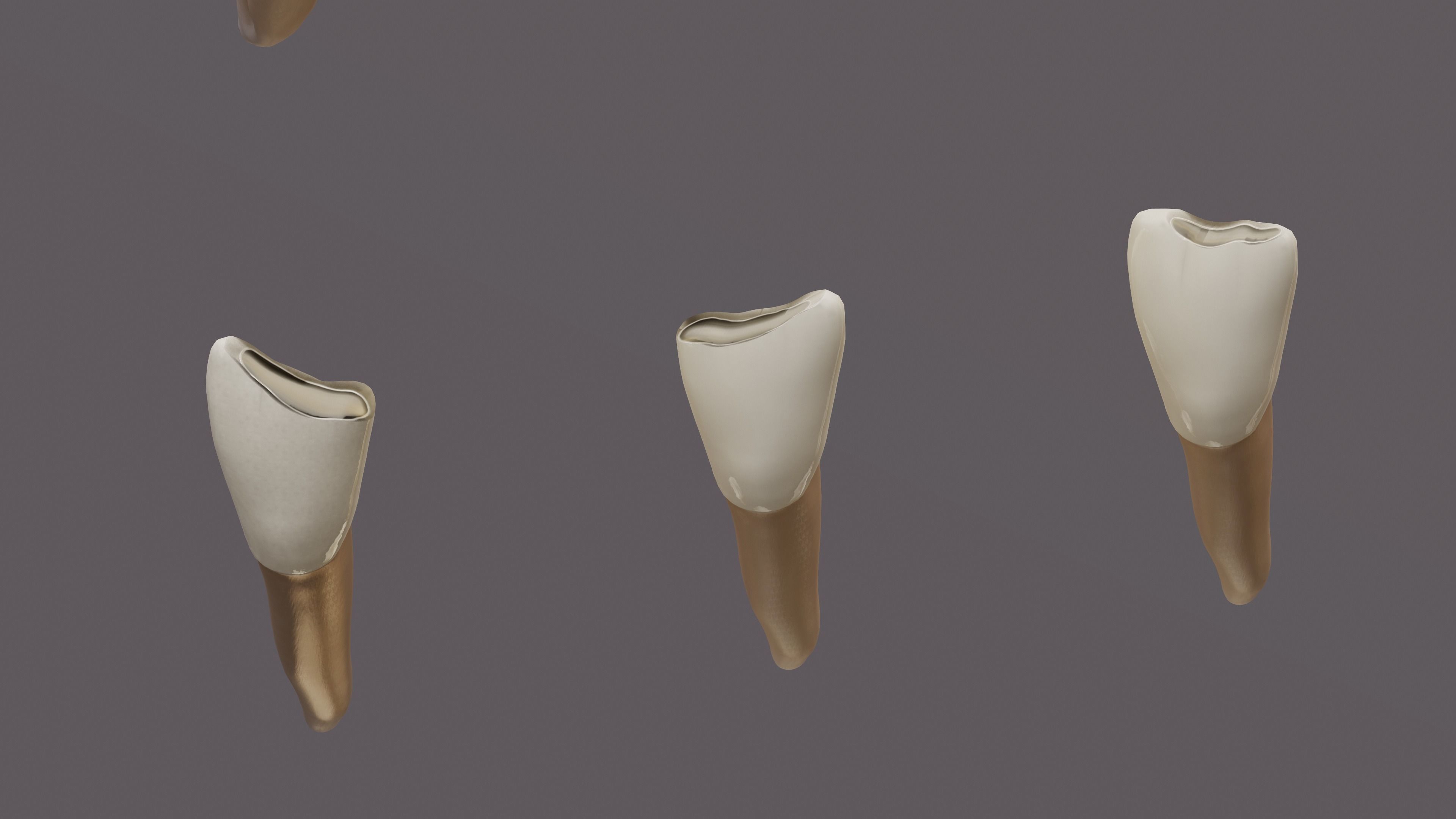 Permanent Teeth class 4 Caries 3D model_7
