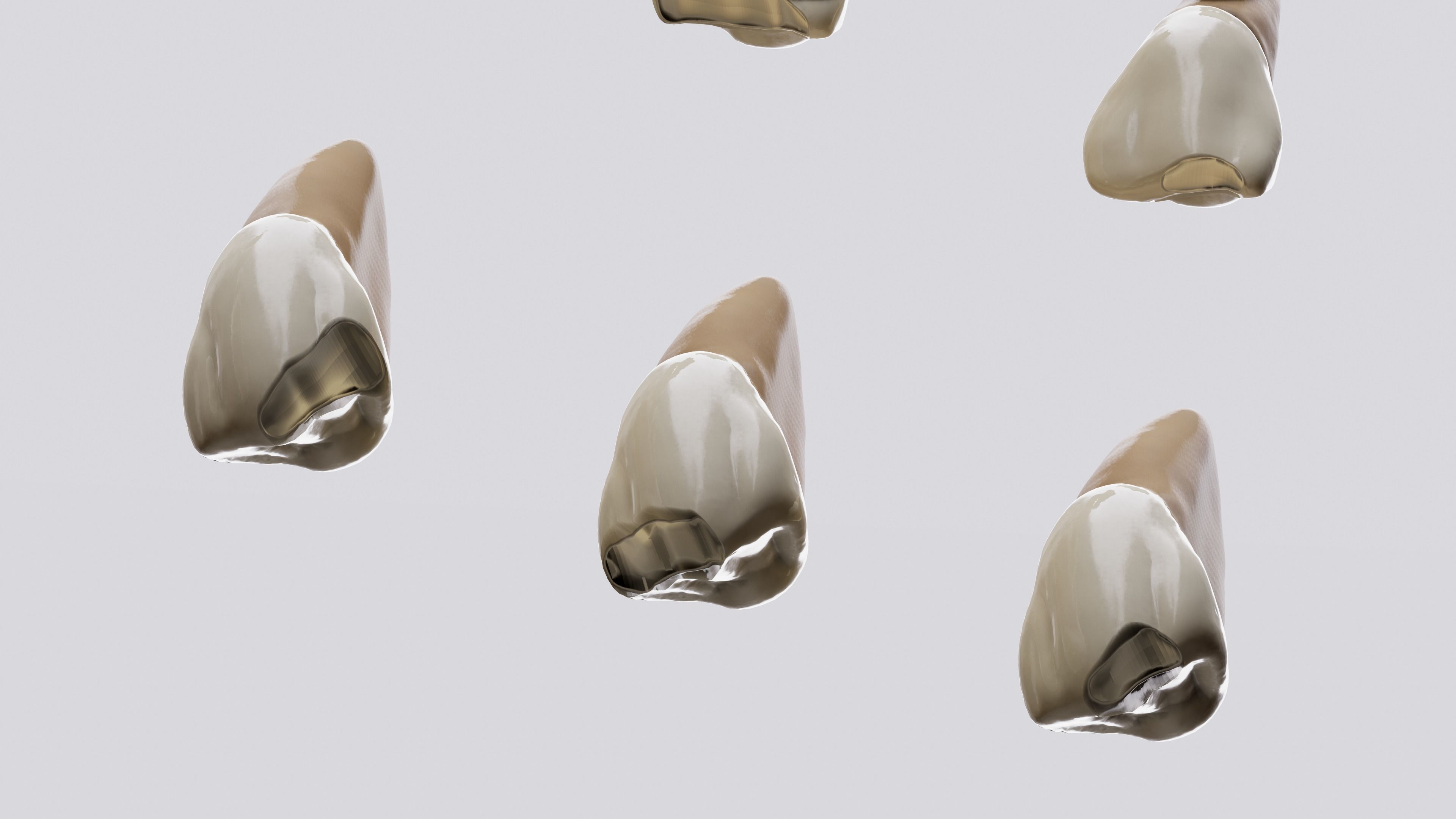 Permanent Teeth class 4 Caries 3D model_5