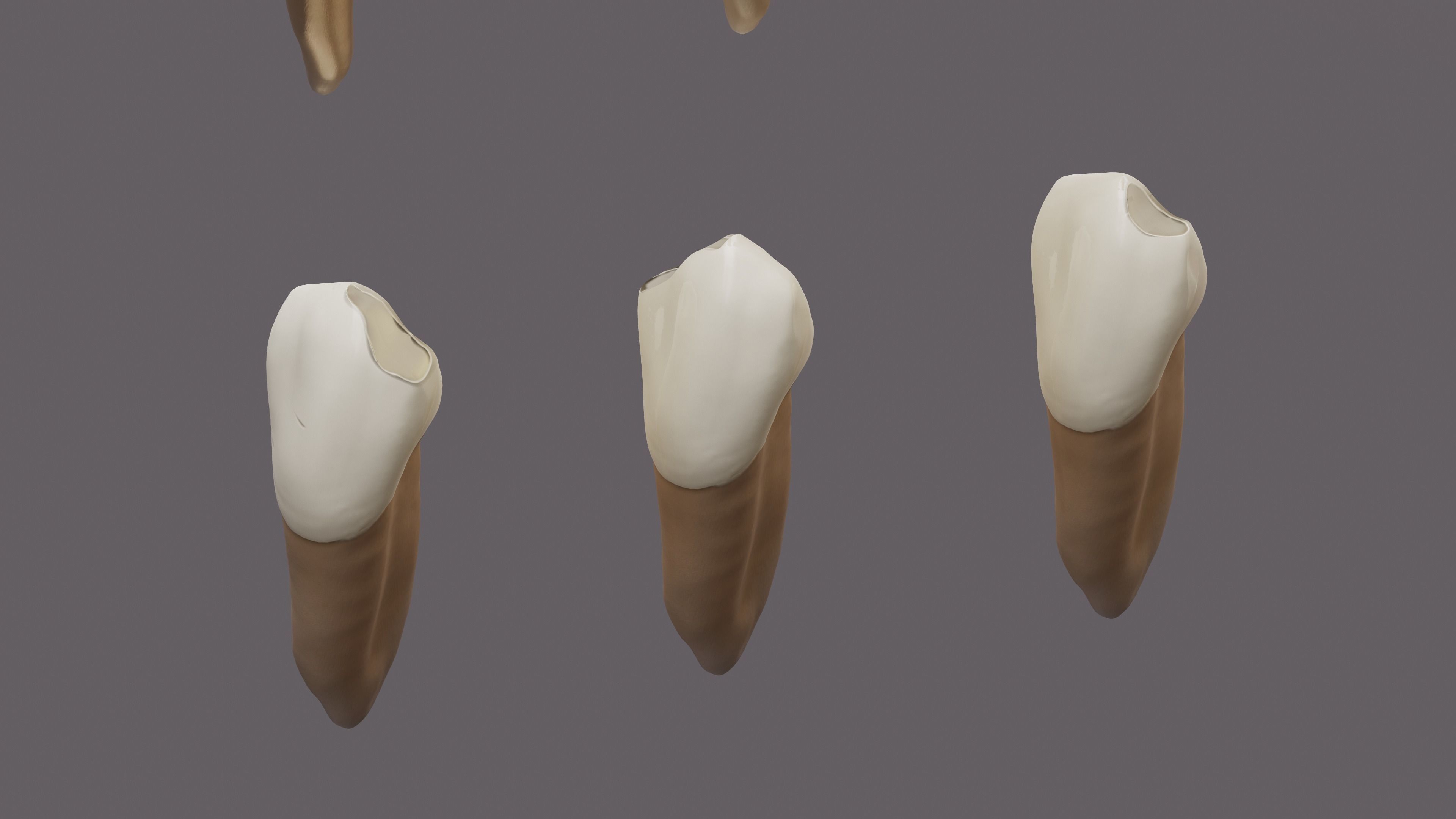 Permanent Teeth class 4 Caries 3D model_6
