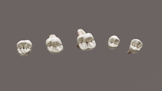 Maxillary Class 1 Caries Low-poly 3D model