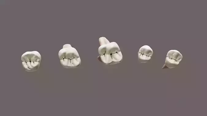 Maxillary Class 1 Caries