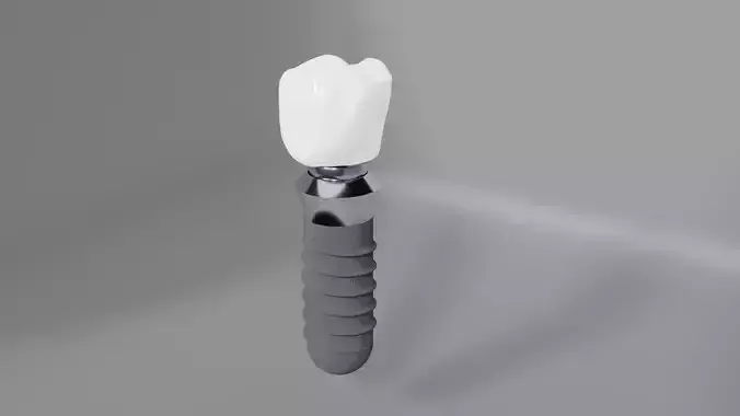 Dental implant crown restoration - High-res 3D model