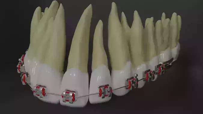 Orthodontic braces - Upper teeth - High res