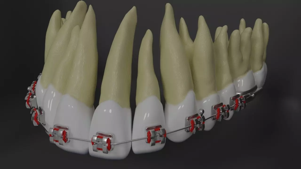 Orthodontic braces - Upper teeth - High res 3D model