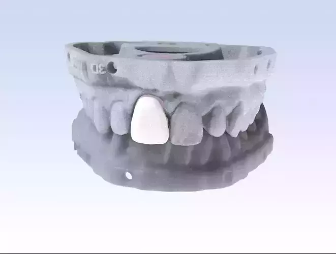 Digital Incisor Veneer Model 3D print model