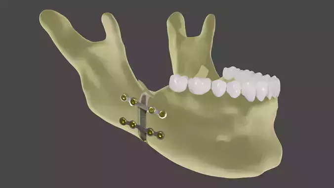 Orthognatic surgery - Titanium plates in the mandible