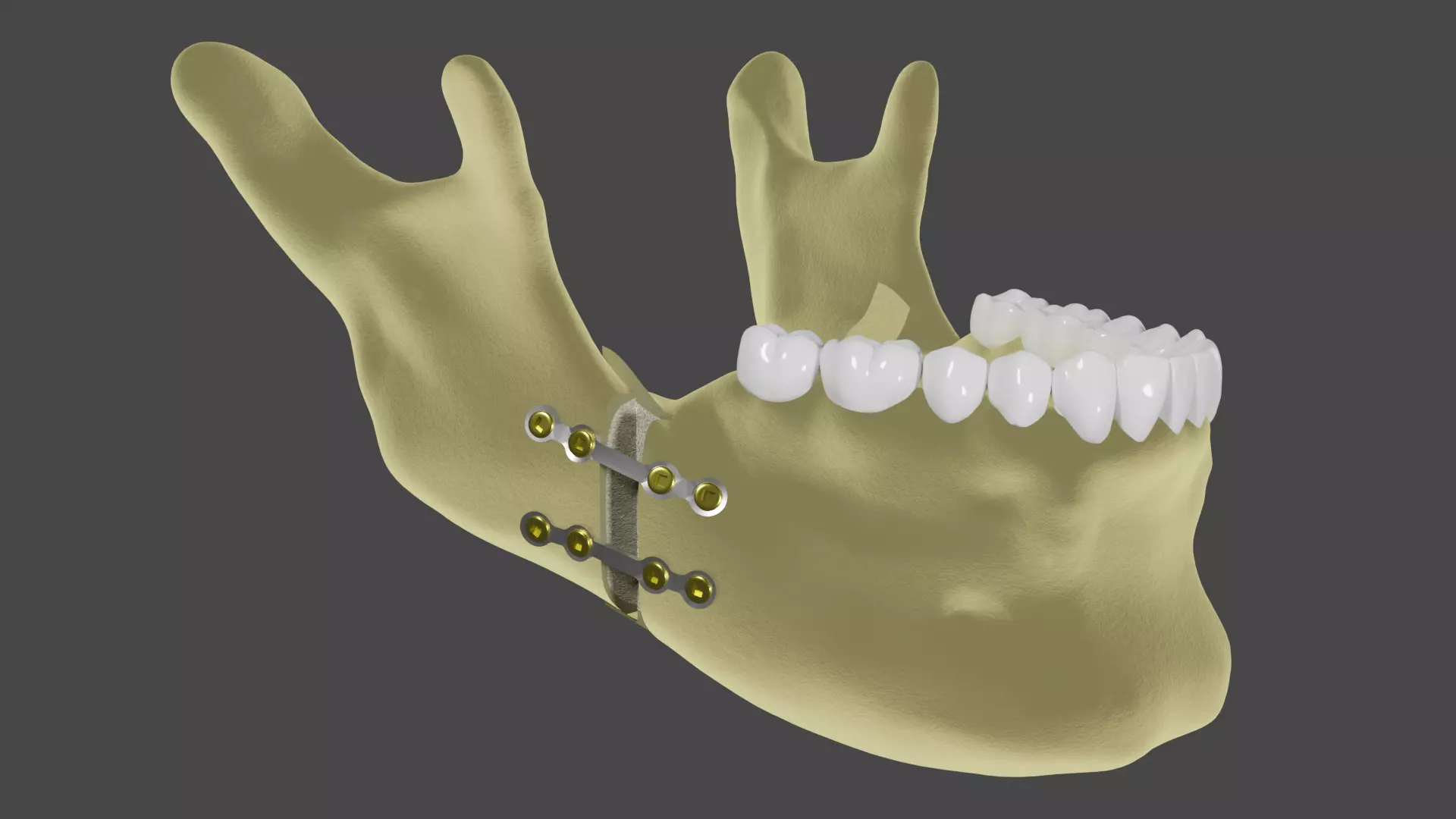 Orthognatic surgery - Titanium plates in the mandible 3D model