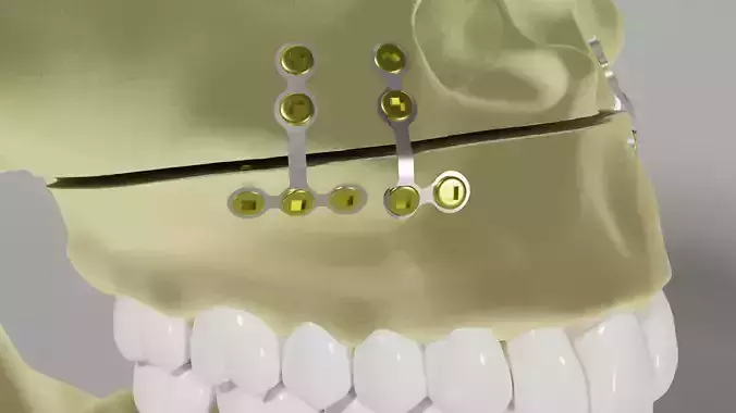 Orthognathic surgery - Titanium plates in the maxillae 3D model