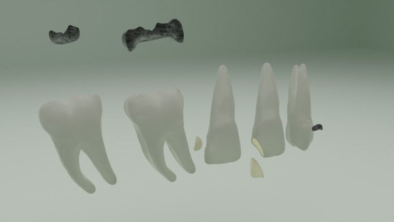 Dental restorations - Blacks Class I to V 3D model_1