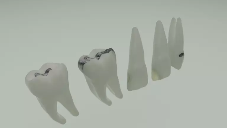 Dental restorations - Blacks Class I to V 3D model_0