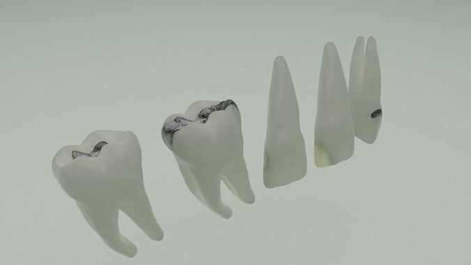 Dental restorations - Blacks Class I to V 3D model