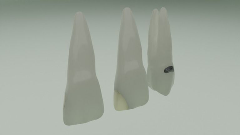 Dental restorations - Blacks Class I to V 3D model_5