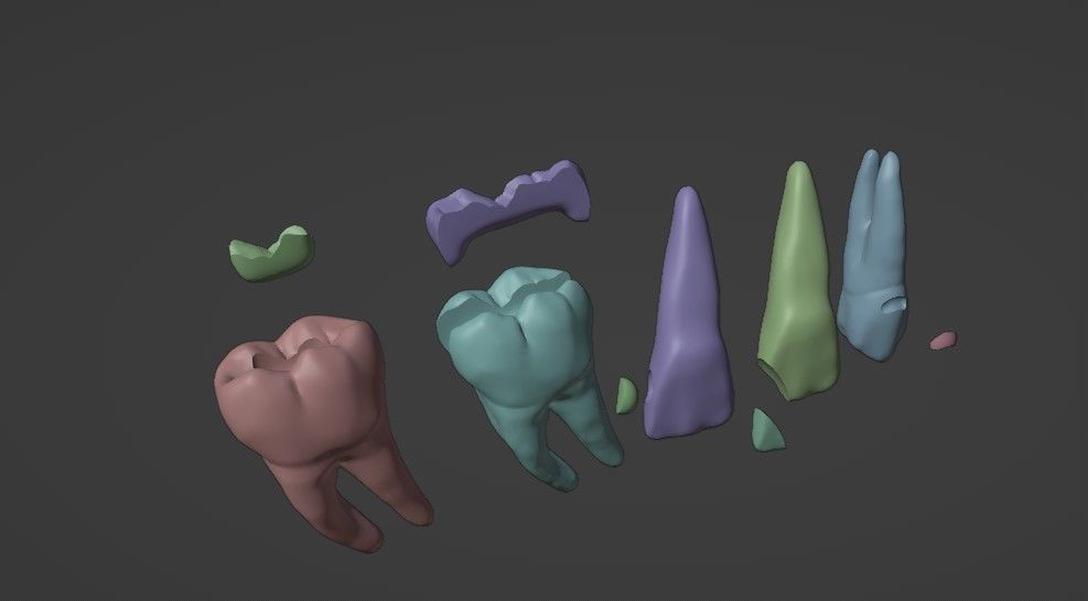 Dental restorations - Blacks Class I to V 3D model_8