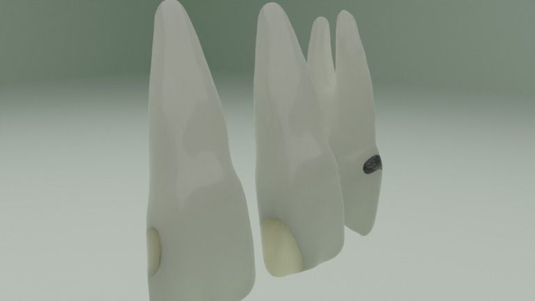 Dental restorations - Blacks Class I to V 3D model_6