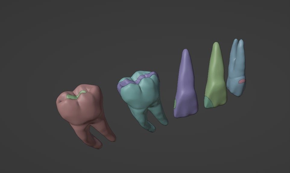 Dental restorations - Blacks Class I to V 3D model_7