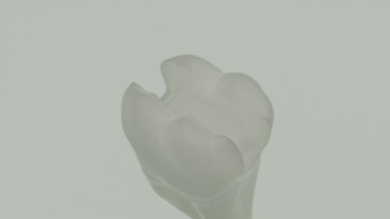 Dental restorations - Blacks Class I to V 3D model_4