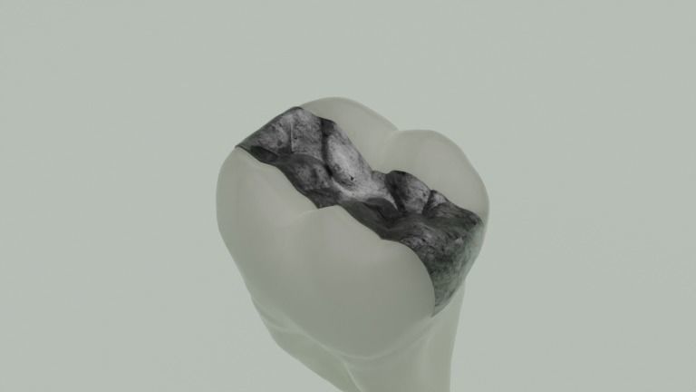 Dental restorations - Blacks Class I to V 3D model_3