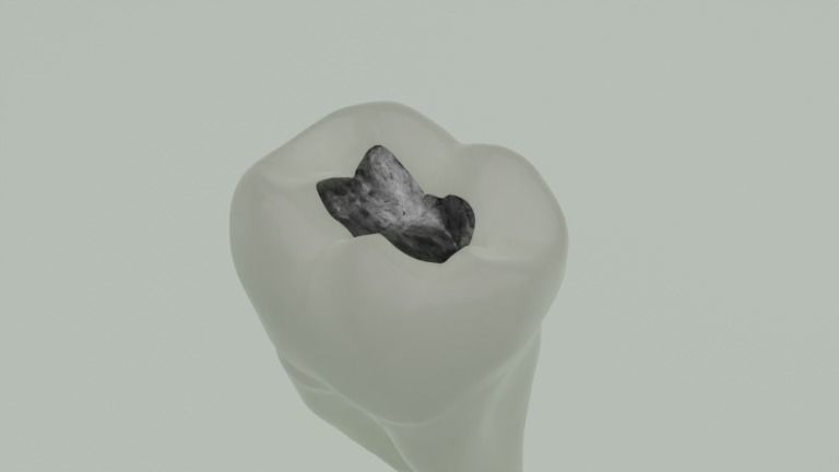 Dental restorations - Blacks Class I to V 3D model_2