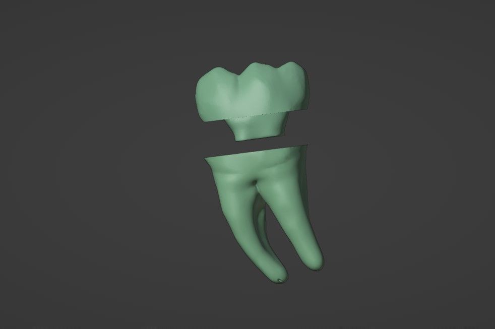 Endocrown restoration 3D model_4
