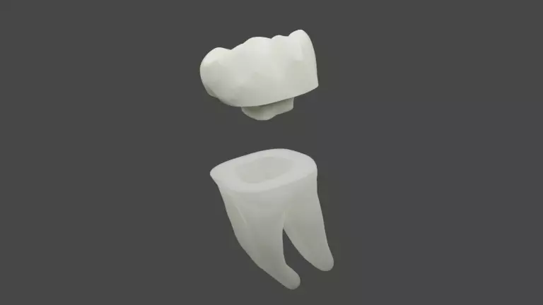 Endocrown restoration 3D model_0