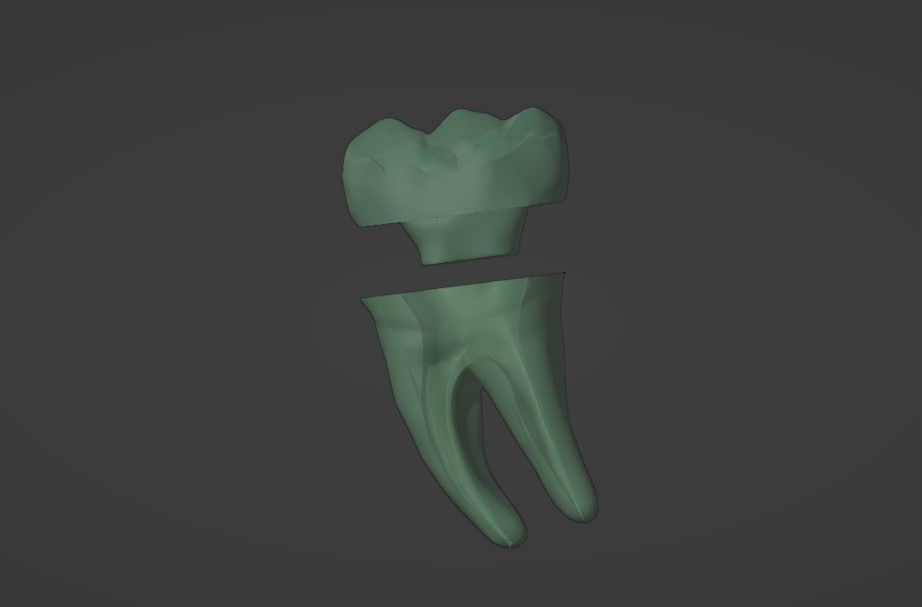 Endocrown restoration 3D model_5