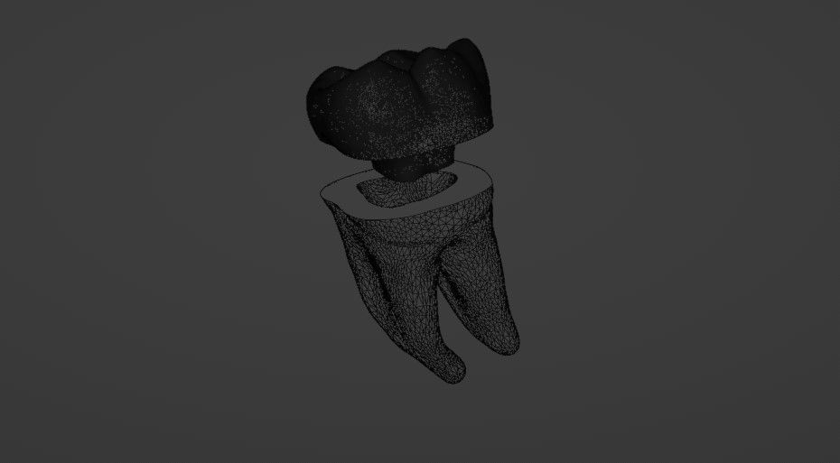 Endocrown restoration 3D model_6
