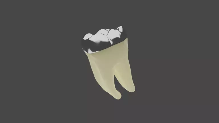 Dental restoration - Metallic Overlay 3D model