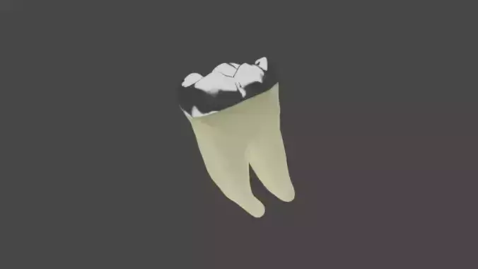 Dental restoration - Metallic Overlay